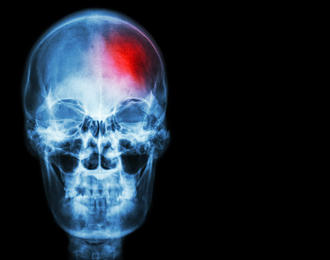 Image of skull with small red dot indicating mini stroke
